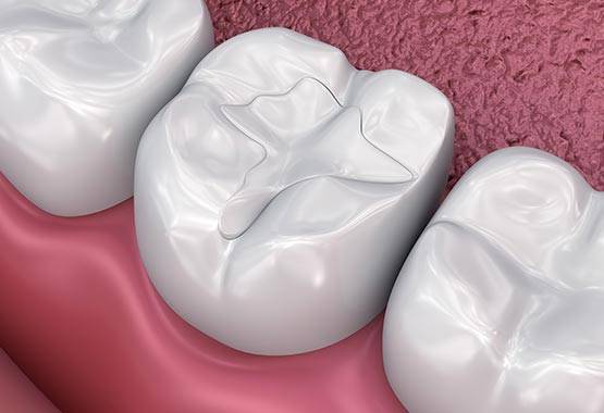 Керамические пломбы