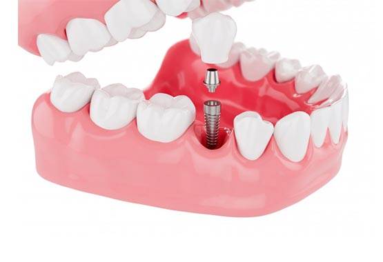 Имплантология