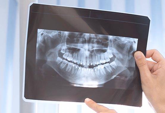 Томография зубов